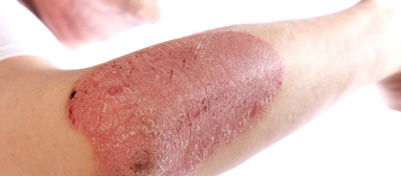 Ψωρίαση: Πότε συμβαίνει και πώς μας επηρεάζει